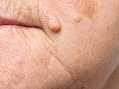 آیا خال‌های گوشتی خطرناک هستند؟ راهنمای کامل تشخیص، علل و زمان مراجعه به پزشک