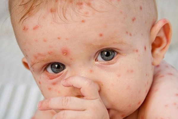 شیوع «آبله مرغان» در بهار