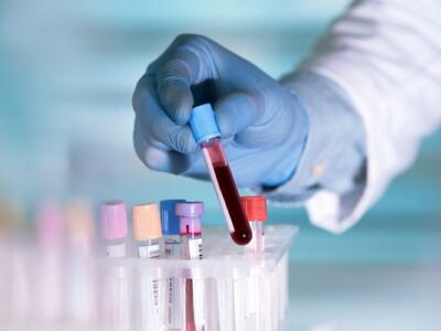 تاثیر آزمایش خون مبتنی بر DNA بر درمان سرطان گلو