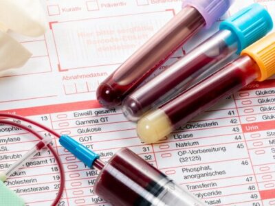 تشخیص خطر سرطان ریه با یک نشانگر خون