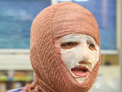 «جان نو» به کمک بیماران سوختگی می‌آید